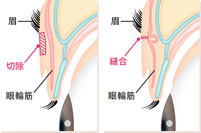 縫合