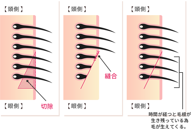 切除法