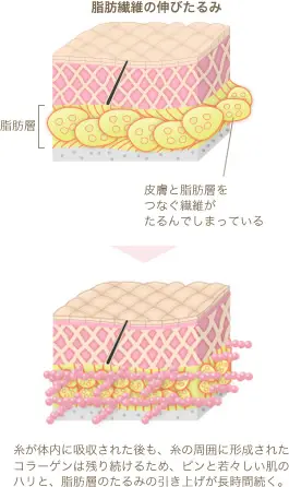 リードファインリフトによる顔のたるみ治療 | セオリークリニック