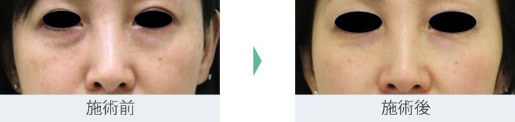 顔のたるみ（シワ・ほうれい線）- マエストラRFの症例写真