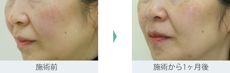 顔のたるみ（シワ・ほうれい線）- リードファインリフトの症例写真