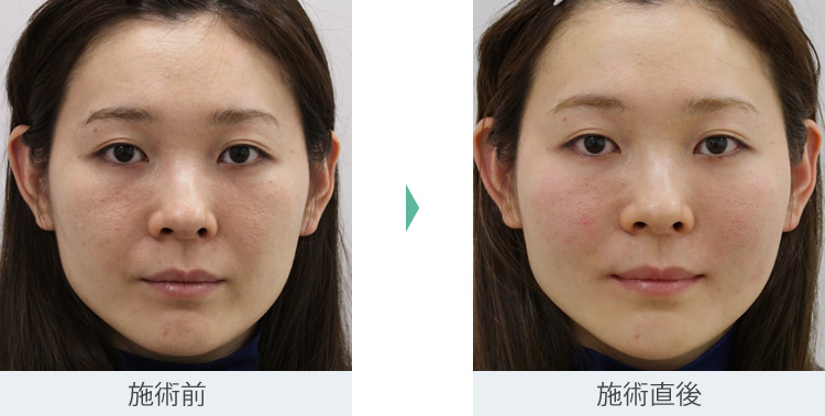 顔のたるみ（シワ・ほうれい線）- 新世代スレッドリフトの症例写真