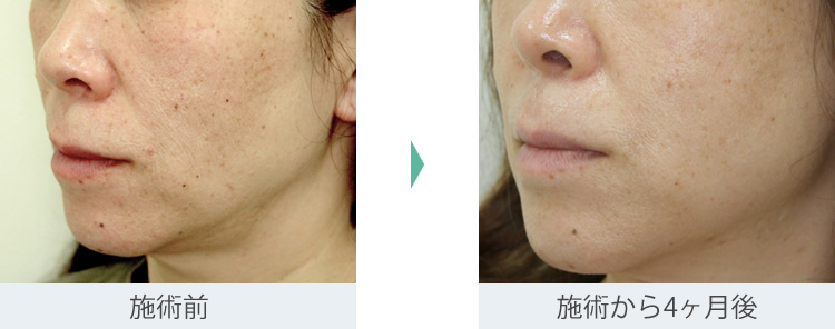 顔のたるみ（シワ・ほうれい線） - タイタンXLの症例写真