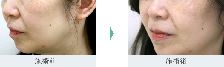 顔のたるみ（シワ・ほうれい線）- サーマクールの症例写真