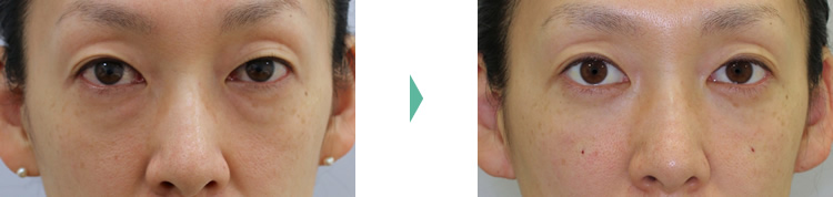 目の下のクマ・たるみ（膨らみ・凹み）- 経結膜脱脂+リポトランスファーの症例写真