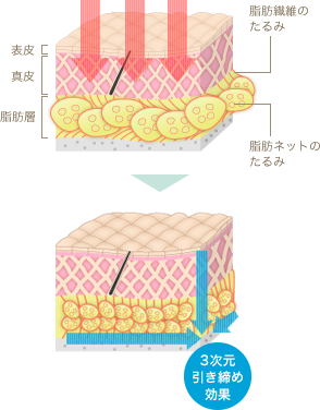 サーマクールCPTによる顔のたるみ(シワ・ほうれい線)治療 サーマクールCPTによる顔のたるみ(シワ・ほうれい線)治療