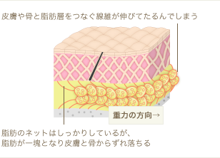 種類2：脂肪繊維の伸びによるたるみ