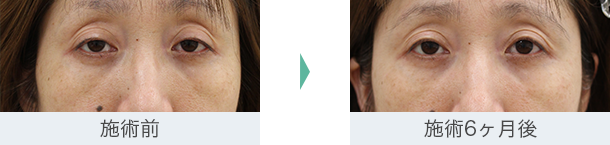 まぶた（たるみ・二重）- 眼瞼下垂術の症例写真