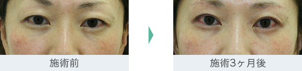 まぶた（たるみ・二重）- 上眼瞼リフト（眉毛下切開）の症例写真