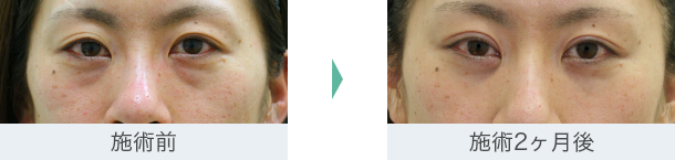 まぶた（たるみ・二重）- 全切開重瞼術の症例写真