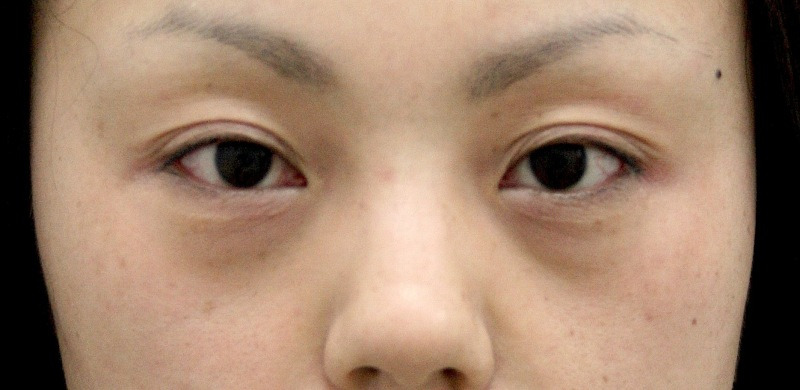 目のクマ・たるみ（膨らみ・凹み）- ヒアルロン酸注入の症例写真(施術前)