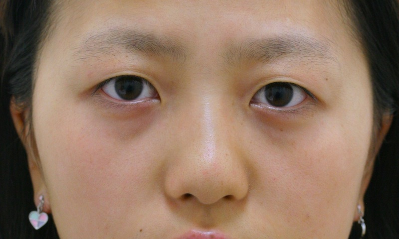 目のクマ・たるみ（膨らみ・凹み）- 経結膜脱脂+リポトランスファーの症例写真(施術前)