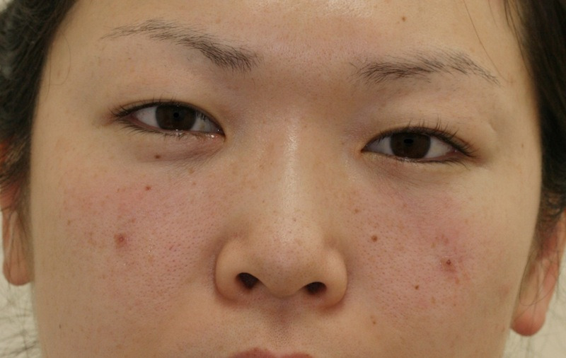 目のクマ・たるみ（膨らみ・凹み）- 経結膜脱脂+リポトランスファーの症例写真(施術後)
