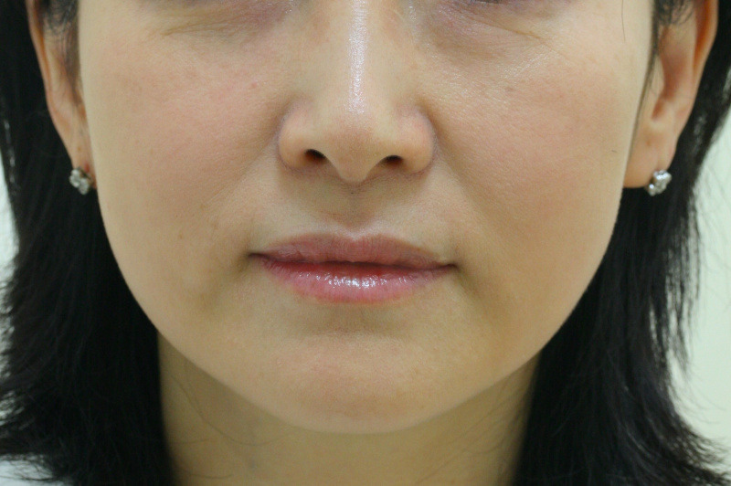 顔のたるみ（シワ・ほうれい線）- リードファインリフトの症例写真(施術前)