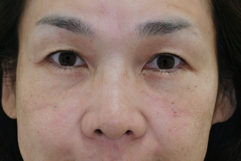 目のクマ・たるみ（膨らみ・凹み）- 脱脂術+リポトランスファーの症例写真(施術後)