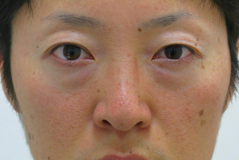 目のクマ・たるみ（膨らみ・凹み）- 脱脂術+リポトランスファーの症例写真(施術前)