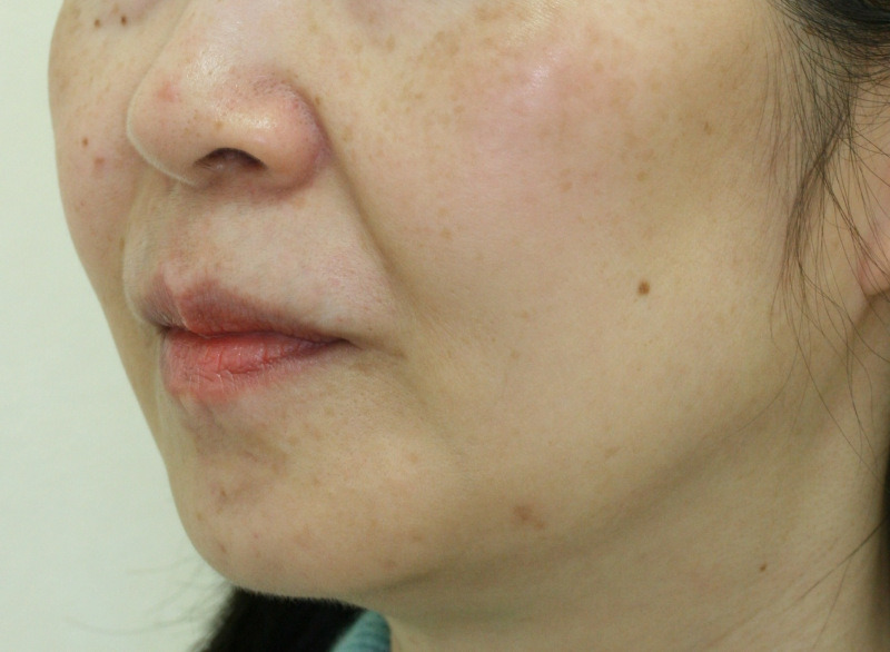顔のたるみ（シワ・ほうれい線）- リードファインリフトの症例写真(施術後)