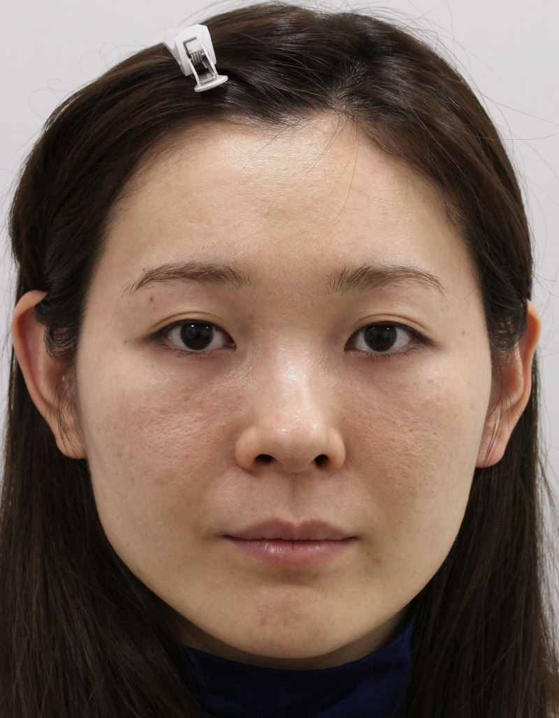 顔のたるみ（シワ・ほうれい線）- 新世代スレッドリフトの症例写真(施術前)