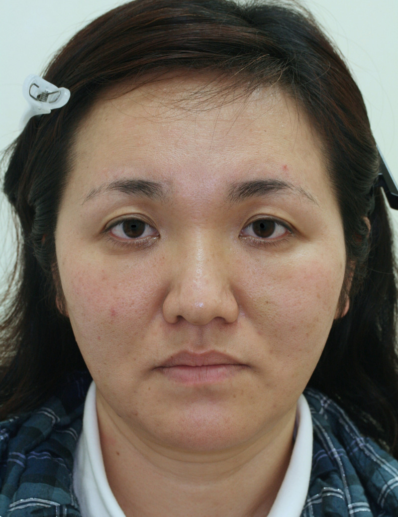 顔のたるみ（シワ・ほうれい線）- リードファインリフトの症例写真(施術後)