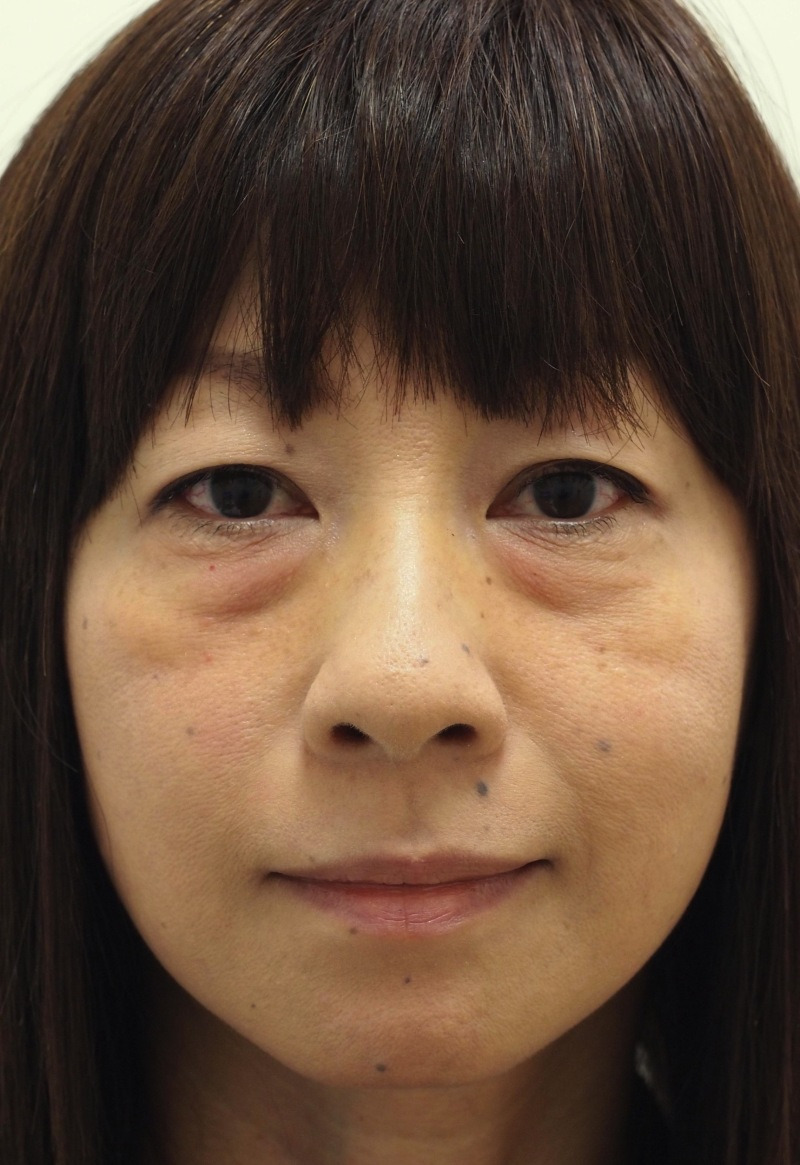 目のクマ・たるみ（膨らみ・凹み）- 経結膜脱脂+リポトランスファー+脂肪注入の症例写真(施術前)