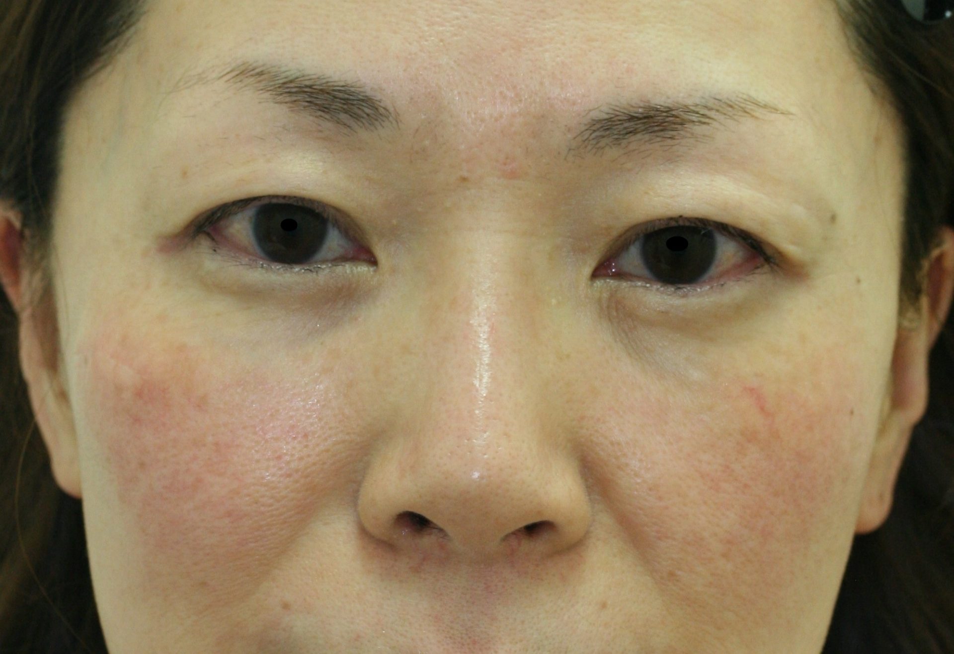 まぶたのたるみ・二重 - 上眼瞼リフト（眉下切開）の症例写真(施術前)