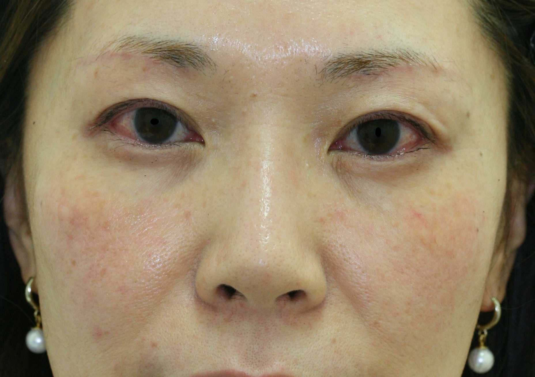 まぶたのたるみ・二重 - 上眼瞼リフト（眉下切開）の症例写真(施術後)