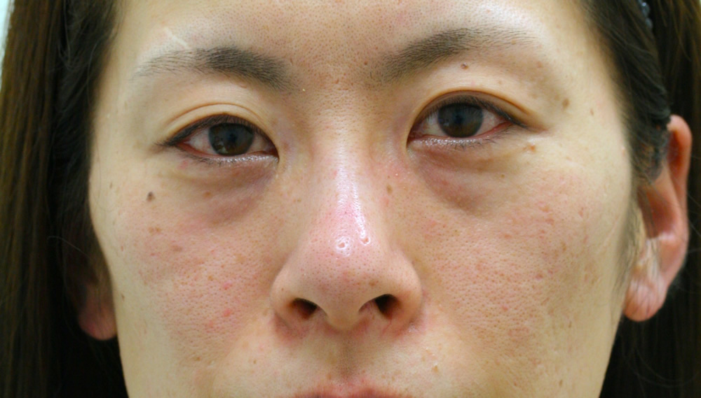まぶたのたるみ・二重 - 全切開重瞼術の症例写真(施術前)