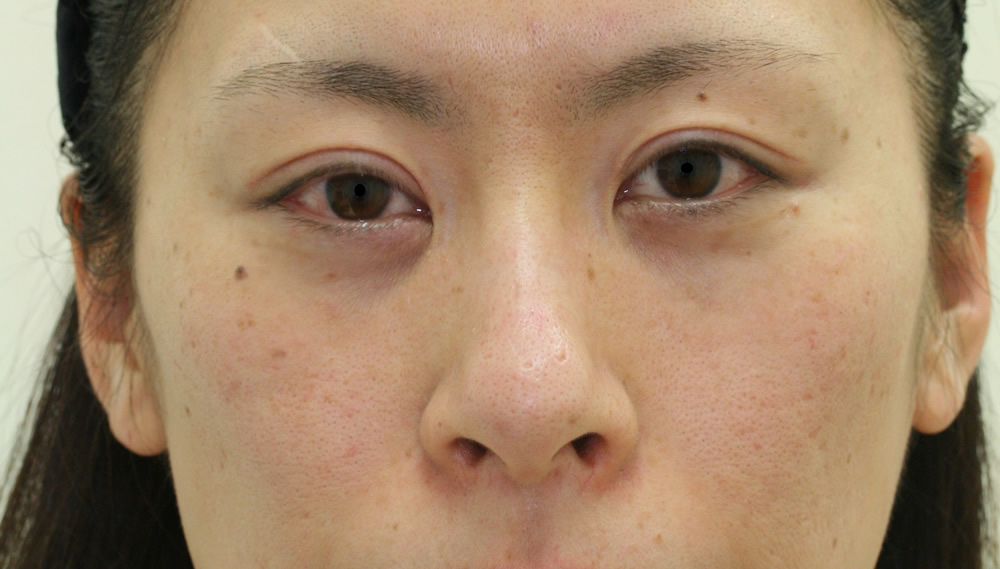 まぶたのたるみ・二重 - 全切開重瞼術の症例写真(施術後)