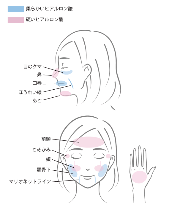 新品「ヒアルロン酸注入治療 安全マニュアル 改訂第2版 必須の知識と事故対策」 ヒアルロン酸注入治療安全マニュアル | 克誠堂出版