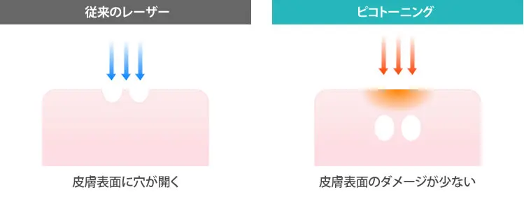 ピコトーニングレーザー ピコトーニング｜医療レーザー外来なら湘南美容クリニック【公式】
