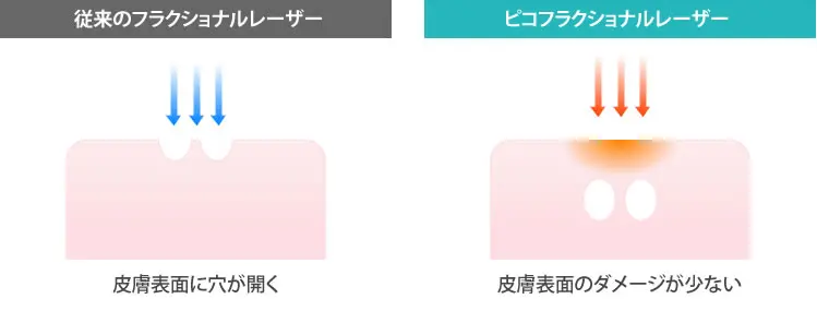 フラクショナル レーザー 日焼け 止め