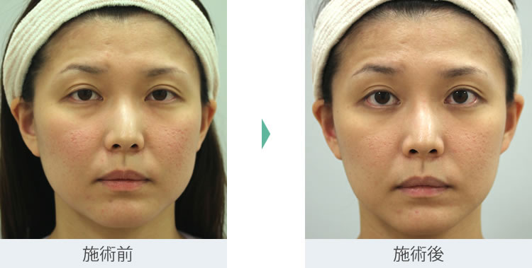 顔のたるみ シワ ほうれい線 治療 バッカルファット除去 セオリークリニック 東京 銀座の美容整形外科