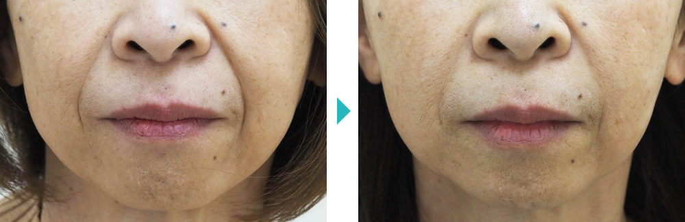 ほうれい線・顔のたるみ治療 おすすめプラン | セオリークリニック 