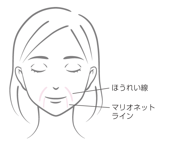 ヒアルロン酸注入