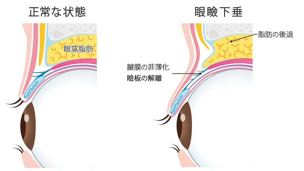 眼瞼下垂の極意　手術　参考書　医学書 切らない眼瞼下垂術 | セオリークリニック- 東京・銀座の美容外科