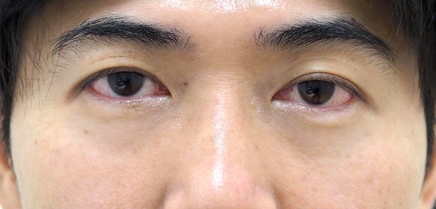目のクマ - 経結膜脱脂＋ピュアグラフティング 37の症例写真(施術前)