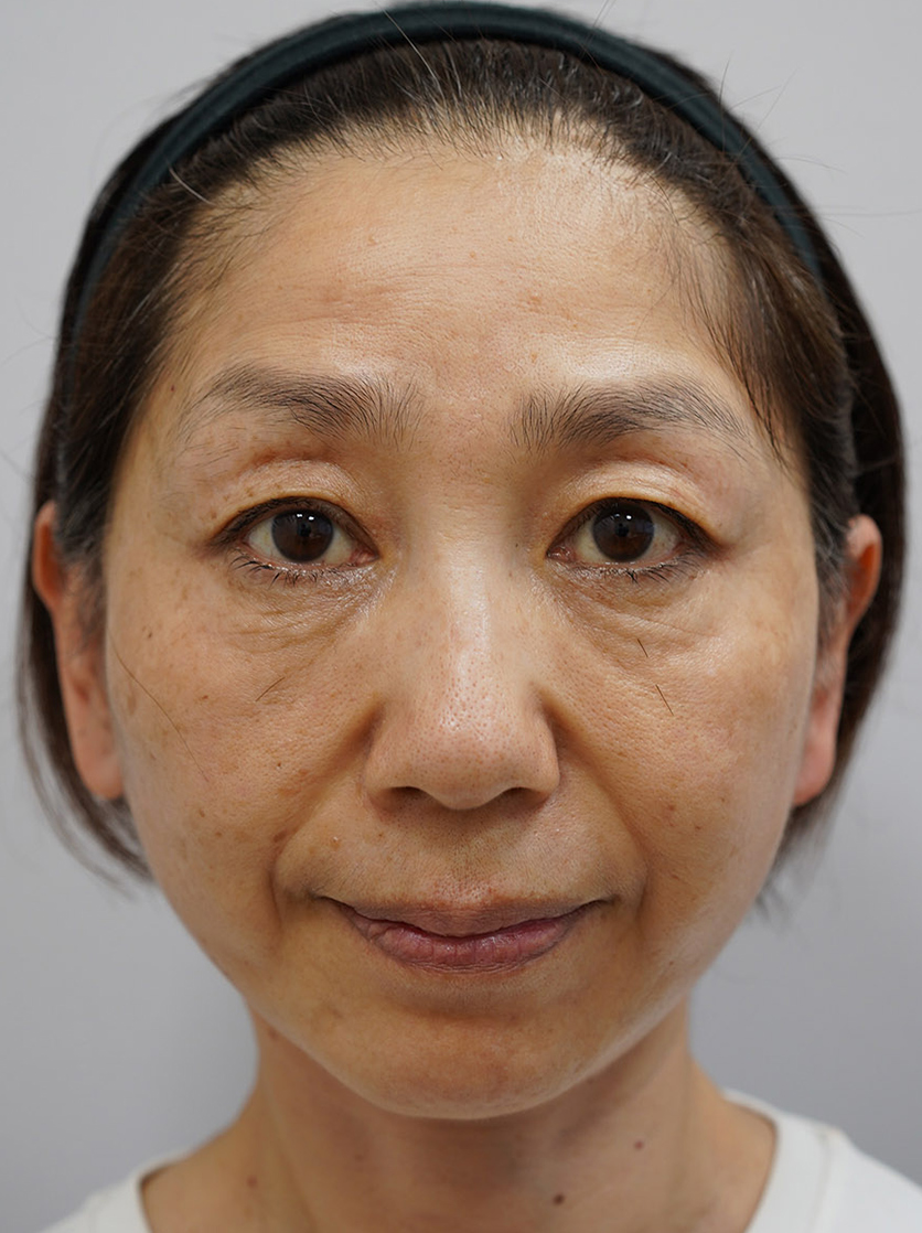 顔のたるみ（シワ・ほうれい線）- 切るフェイスリフトの症例写真(施術後)
