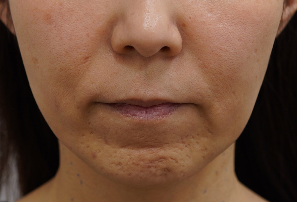 顔のたるみ（シワ・ほうれい線） - 切るフェイスリフトの症例写真(施術前)