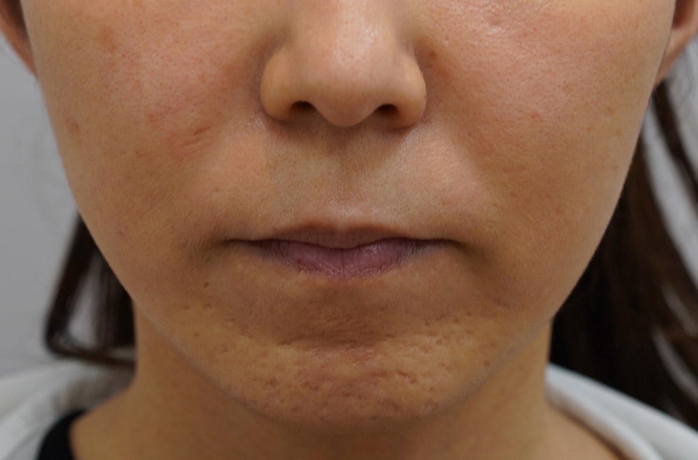 顔のたるみ（シワ・ほうれい線）- 切るフェイスリフトの症例写真(施術後)