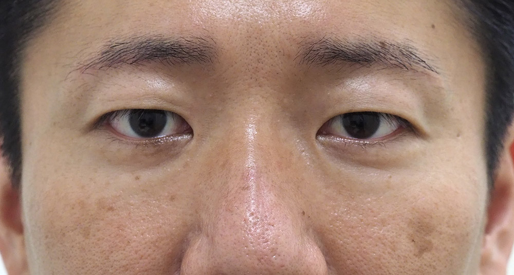 まぶたのたるみ・二重 - A：眉下切開（眉下リフト）
B：ROOF切除の症例写真(施術後)