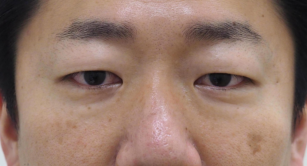 まぶたのたるみ・二重 - A：眉下切開（眉下リフト）
B：ROOF切除の症例写真(施術前)