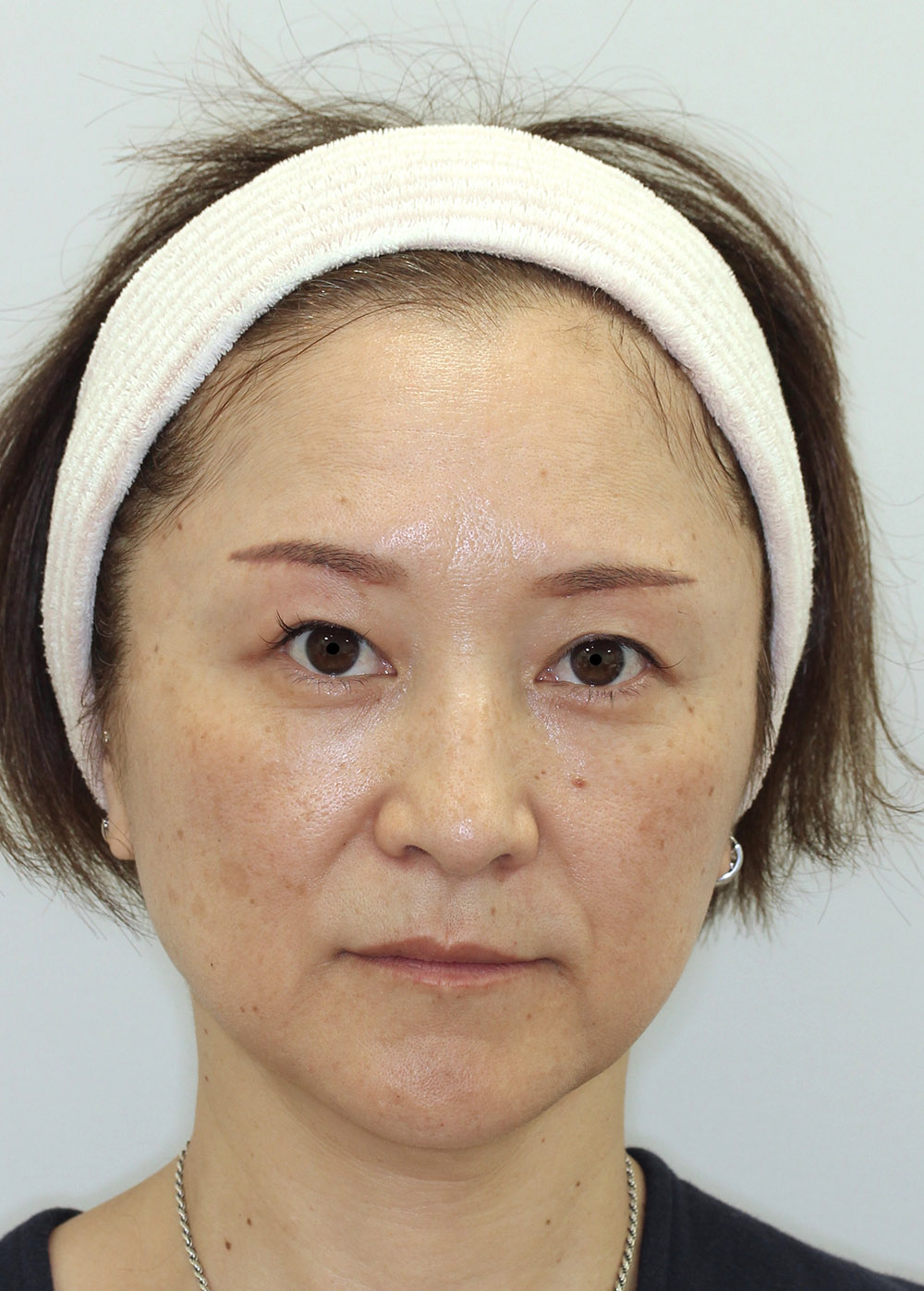 まぶたのたるみ・二重 - A：眉下切開
B：経結膜脱脂+ピュアグラフティングの症例写真(施術後)