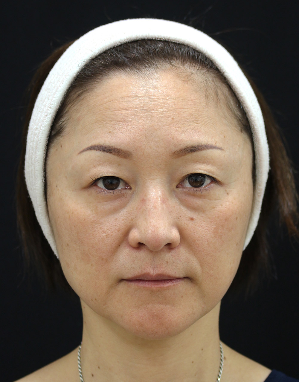 まぶたのたるみ・二重 - A：眉下切開
B：経結膜脱脂+ピュアグラフティングの症例写真(施術前)