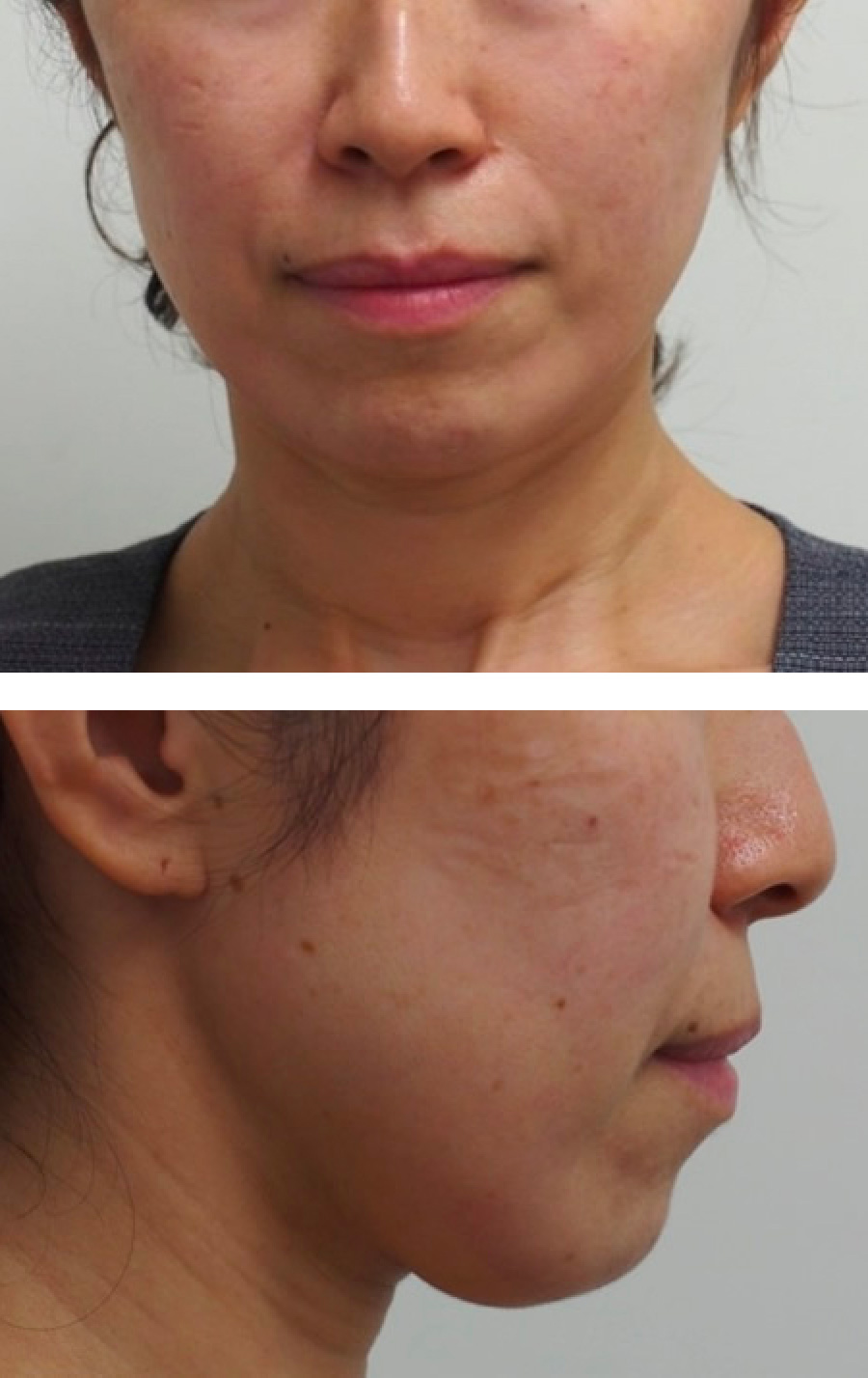 顔のたるみ（シワ・ほうれい線） - ヒアルロン酸リフトの症例写真(施術前)