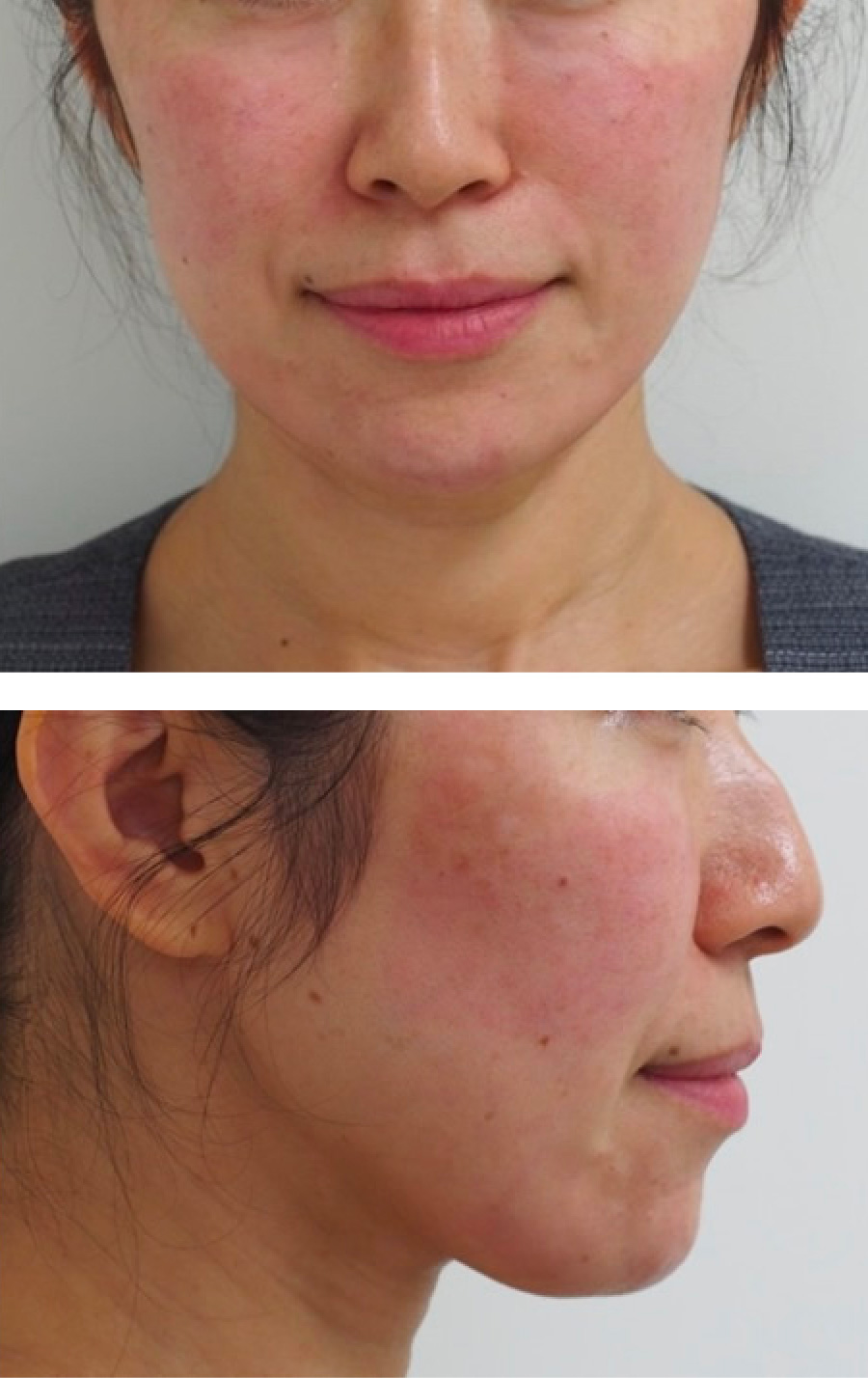 顔のたるみ（シワ・ほうれい線） - ヒアルロン酸リフトの症例写真(施術後)