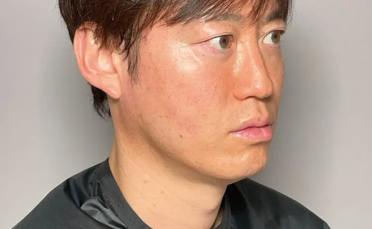 糸リフト（新世代スレッドリフト）によるほうれい線治療 | セオリー
