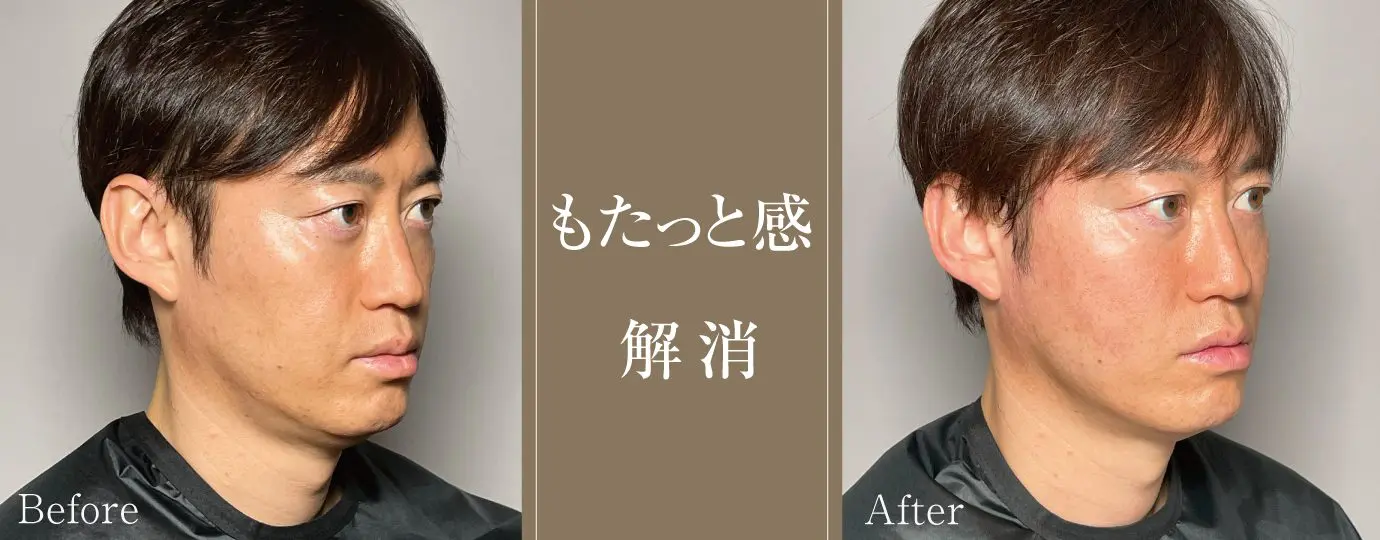 スレッドリフトのセオリー　PINCH解剖学とテクニック スレッドリフトのセオリー | Bongcheol Kim, Seungmin Oh