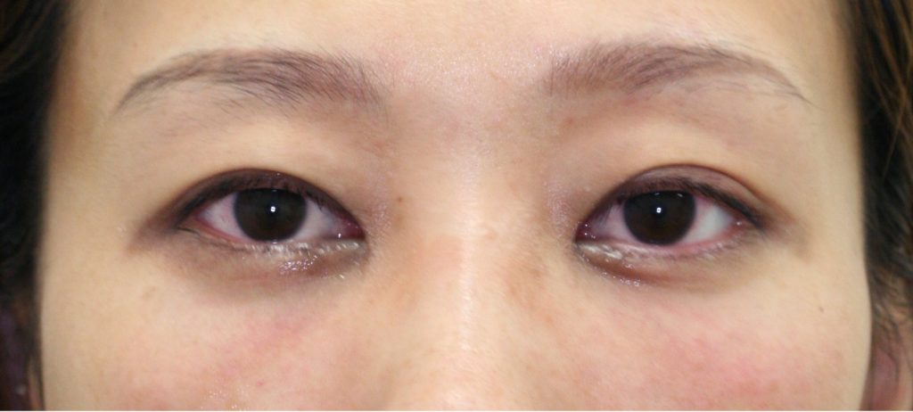他院修正の治療後写真