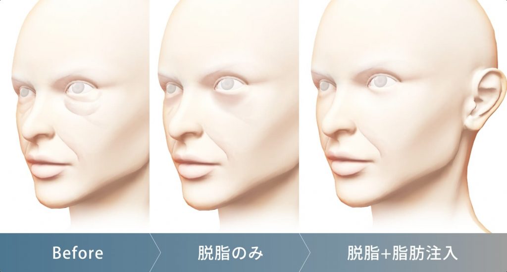 脱脂のみ、脱脂+脂肪注入の違い