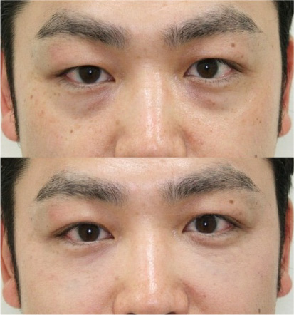 黒クマ ヒアルロン酸注入 ビフォーアフター